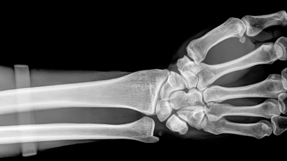 How Much Does Disability Pay For Arthritis